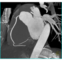 Volume Rendering and MIP of Vessels - CTisus CT Scan