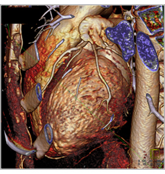 Volume Rendering and MIP of Vessels - CTisus CT Scan