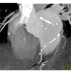 Extensive Left Anterior Descending Coronary Artery (LAD) Disease - CTisus CT Scan