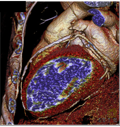 Extensive Left Anterior Descending Coronary Artery (LAD) Disease - CTisus CT Scan