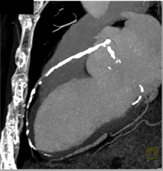 Extensive Left Anterior Descending Coronary Artery (LAD) Disease - CTisus CT Scan