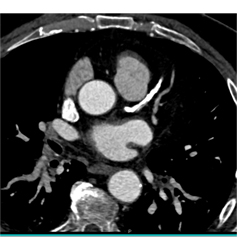 Extensive Left Anterior Descending Coronary Artery (LAD) Disease - CTisus CT Scan