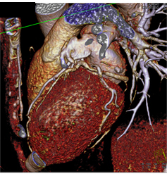 Normal Left Atrial Appendage - CTisus CT Scan