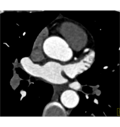 Normal Left Atrial Appendage - CTisus CT Scan