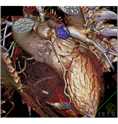 Normal Left Atrial Appendage - CTisus CT Scan