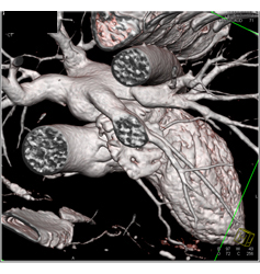 Normal Left Atrial Appendage - CTisus CT Scan