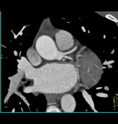 Pericardial Calcification - CTisus CT Scan