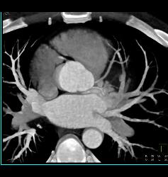 Normal Left Anterior Descending Coronary Artery (LAD) in Various Renderings - CTisus CT Scan