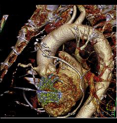 Normal Left Anterior Descending Coronary Artery (LAD) in Various Renderings - CTisus CT Scan