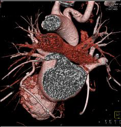 Normal Left Anterior Descending Coronary Artery (LAD) in Various Renderings - CTisus CT Scan