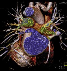 Left Anterior Descending Coronary Artery (LAD) Plaque - CTisus CT Scan