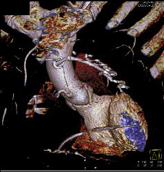 Normal Left Anterior Descending Coronary Artery (LAD) in Various Renderings - CTisus CT Scan