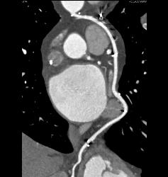 Normal Left Anterior Descending Coronary Artery (LAD) in Various Renderings - CTisus CT Scan