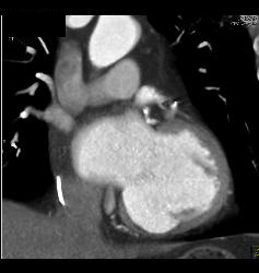 Normal Left Anterior Descending Coronary Artery (LAD) in Various ...