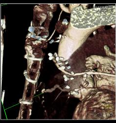 Stent in RCA - CTisus CT Scan