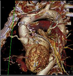 Soft Plaque in Left Anterior Descending Coronary Artery (LAD) - CTisus CT Scan