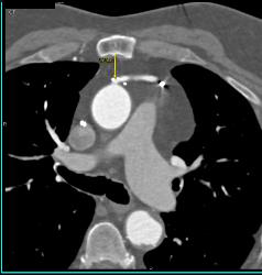 Stent in RCA - CTisus CT Scan