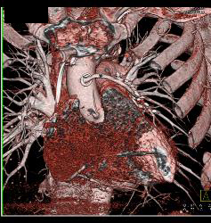 Calcified and Noncalcified Lca Plaque - CTisus CT Scan