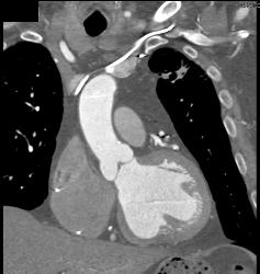 Calcified and Noncalcified Lca Plaque - CTisus CT Scan