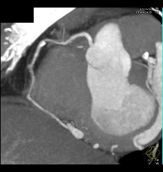 Calcified and Noncalcified Lca Plaque - CTisus CT Scan