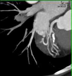 Calcified and Noncalcified Lca Plaque - CTisus CT Scan