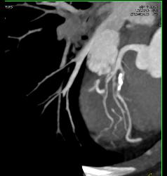 Calcified and Noncalcified Lca Plaque - CTisus CT Scan