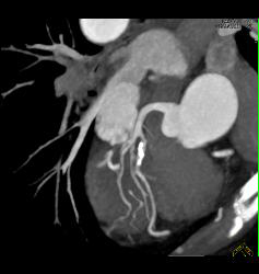 Stent in RCA - CTisus CT Scan