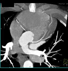 Minimal Left Anterior Descending Coronary Artery (LAD) Disease - CTisus CT Scan