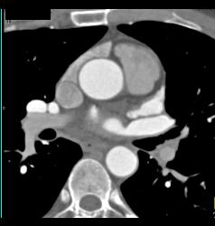 Minimal Left Anterior Descending Coronary Artery (LAD) Disease - CTisus CT Scan