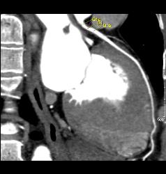 Minimal Left Anterior Descending Coronary Artery (LAD) Disease - CTisus CT Scan