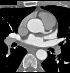 Stent in RCA - CTisus CT Scan