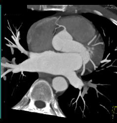 Stent in RCA - CTisus CT Scan