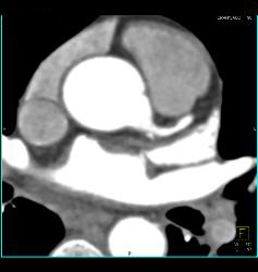 Stent in RCA - CTisus CT Scan