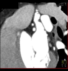 Stent in RCA - CTisus CT Scan