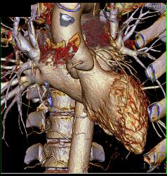 Left Anterior Descending Coronary Artery (LAD) Disease With Almost 50% Stenosis - CTisus CT Scan