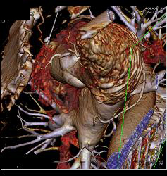 Left Anterior Descending Coronary Artery (LAD) Disease With Almost 50% Stenosis - CTisus CT Scan