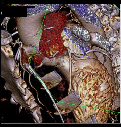 Left Anterior Descending Coronary Artery (LAD) Disease With Almost 50% Stenosis - CTisus CT Scan