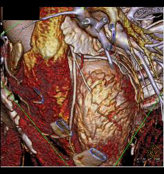 Stent in RCA - CTisus CT Scan