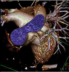 Stent in RCA - CTisus CT Scan