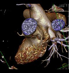 Stent in RCA - CTisus CT Scan