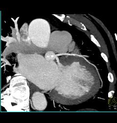 Stent in RCA - CTisus CT Scan