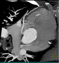 Dilated Origin of Reimplanted RCA and Left Main Coronary Artery - CTisus CT Scan