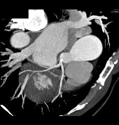 Dilated Origin of Reimplanted RCA and Left Main Coronary Artery - CTisus CT Scan