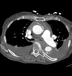 Dilated Origin of Reimplanted RCA and Left Main Coronary Artery - CTisus CT Scan