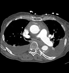 Dilated Origin of Reimplanted RCA and Left Main Coronary Artery - CTisus CT Scan