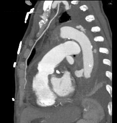 Dilated Origin of Reimplanted RCA and Left Main Coronary Artery - CTisus CT Scan