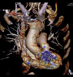 Dilated Origin of Reimplanted RCA and Left Main Coronary Artery - CTisus CT Scan