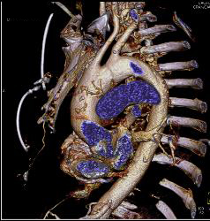 Dilated Origin of Reimplanted RCA and Left Main Coronary Artery - CTisus CT Scan