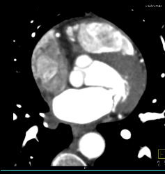 Dilated Origin of Reimplanted RCA and Left Main Coronary Artery - CTisus CT Scan