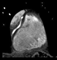 Dilated Origin of Reimplanted RCA and Left Main Coronary Artery - CTisus CT Scan